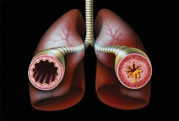 Бронхіальна астма