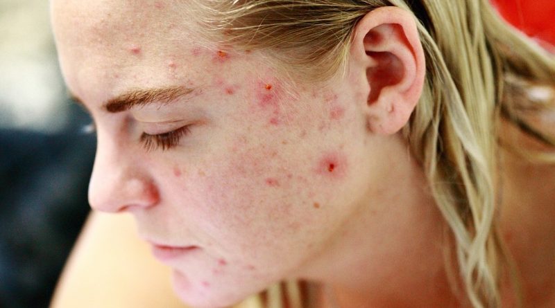 Червоні вугрі