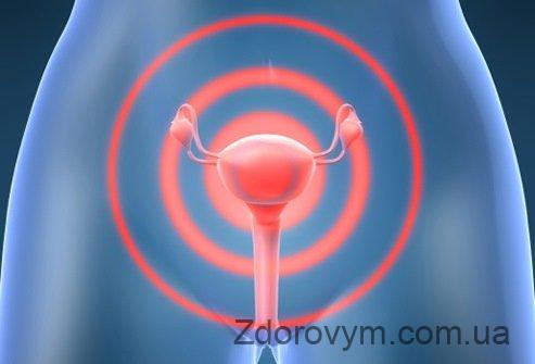 Кольпіт у жінок - причини