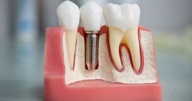 Зубні імплантати