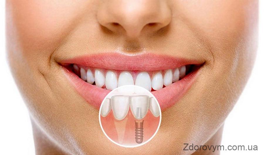 Зубні імплантанти 