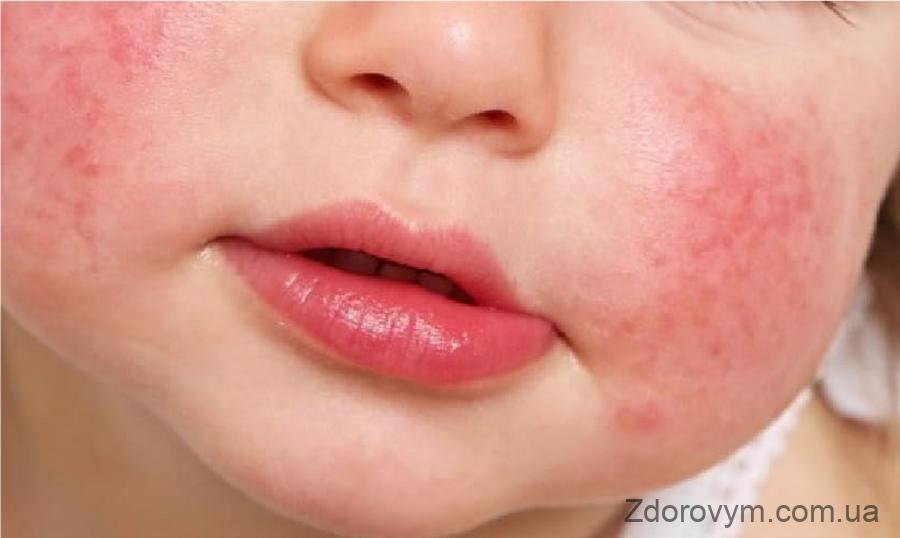Ознаки атопічного дерматиту у дітей