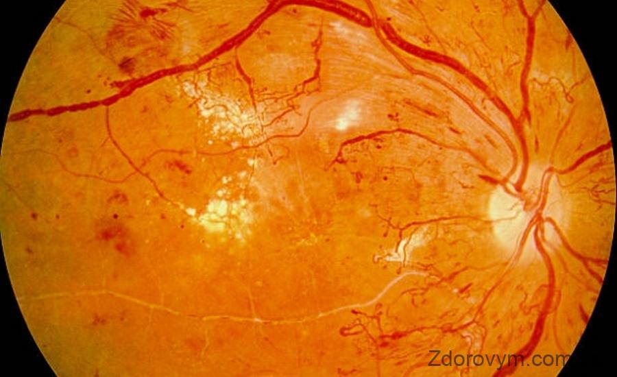 Симптоми діабетичної ретинопатії