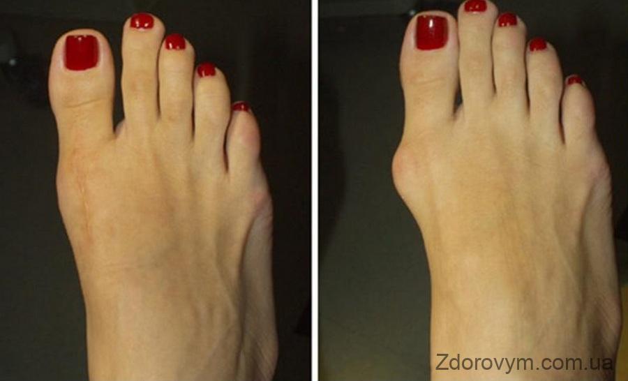 Симптоми вальгусної деформації великого пальця ноги